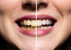 Zubni kamenac - što je i kako ga se riješiti