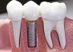 Što su dentalni implantati?