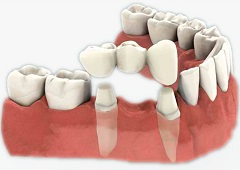 Sve što trebate znati o zubnim krunicama i mostovima