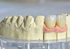Pravilno održavanje zubnih krunica i mostova