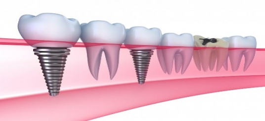 Osnovne informacije o dentalnoj implantologiji