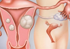 Najčešći benigni tumor u ženskom traktu - miom