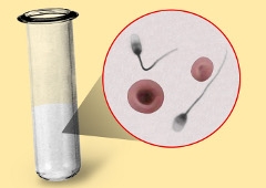 Krv u spermi - hematospermia