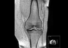 de ce durează articulațiile genunchilor artrite reattiva bambini