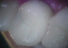 Fraktura ili puknuće krune zuba