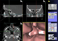 3D-N-CAS-FESS-operacija nosa, sinusa i baze lubanje