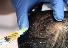 PRP (terapija vlastitom krvlju) - primjena kod gubitka kose