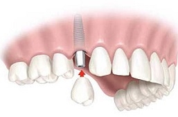 Kako najefikasnije riješiti nedostatak zubi? Jeste li baš Vi kandidat za zubni implantat?