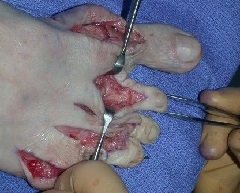 Minimalno invazivna kirurgija stopala