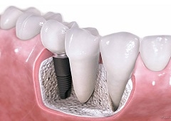 Tijek i ugradnja zubnih implatata