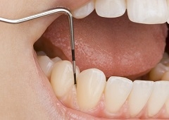 Krvarenje zubnog mesa vodi parodontozi