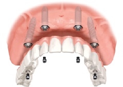 Saznajte sve što ste oduvijek željeli znati o zubnim implantatima!