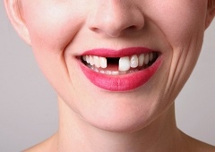 Zašto je zubni implantat najbolji način za nadoknadu zuba?