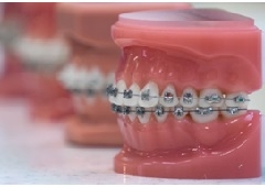 Oštećuje li ortodonski aparatić zubnu caklinu?