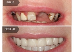 Zašto nadomjestiti zub netom nakon gubitka?