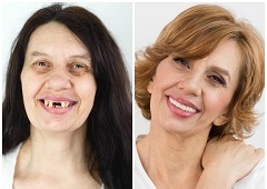 Kombinacijom različitih grana stomatologije do transformacije osmijeha