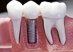 Zubni implantati - tko ih ugrađuje i što se ugrađuje?