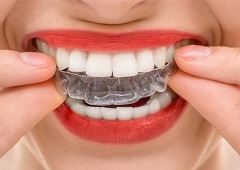 Najnoviji trend u ortodonciji – prozirne udlage umjesto bravica