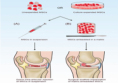 Kosti i zglobovi: Liječenje zglobova matičnim stanicama