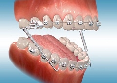 Mijenjanje žice na fiksnom zubnom aparatiću (video)