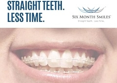 "Six Month Smiles" - ortodontski aparatić