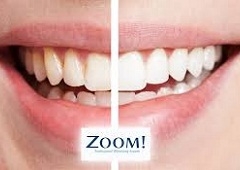 Zoom izbjeljivanje zubi