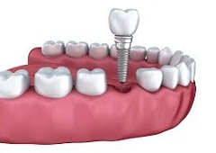 Zubne krunice i mostovi