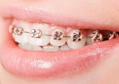 Postavljanje fiksnog ortodontskog aparatića