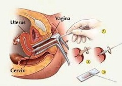 Brisevi rodnice, cervixa i uretre