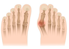 Operacija deformacije stopala - čukalj - hallux valgus