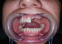 Implantologija i oralna kirurgija