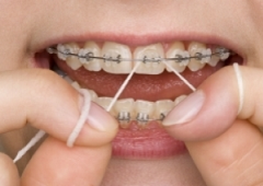Održavanje higijene sa zubnim aparatićem
