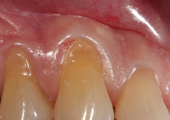 Parodontologija - kako izliječiti parodontitis?
