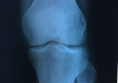 Endoproteza koljena