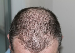 TrichoTest™ - Personalizirano liječenje alopecije