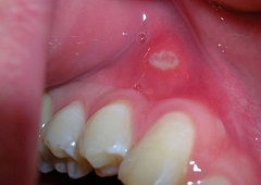 Uloga doktora dentalne medicine u ranom otkrivanju zločudnih bolesti u usnoj šupljini