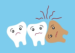 Što je to impaktirani zub?