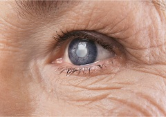 Glaukom - sprječavanje i liječenje