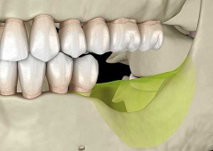 Koliko traju zubni implantati? Evo što kaže doktorica Tarle...