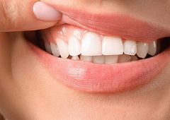 Povlačenje zubnog mesa – uzroci, simptomi i prevencija
