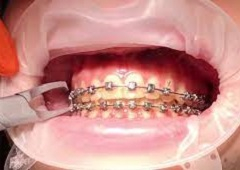 Poliranje zubi nakon skidanja fiksnog ortodontskog aparatića